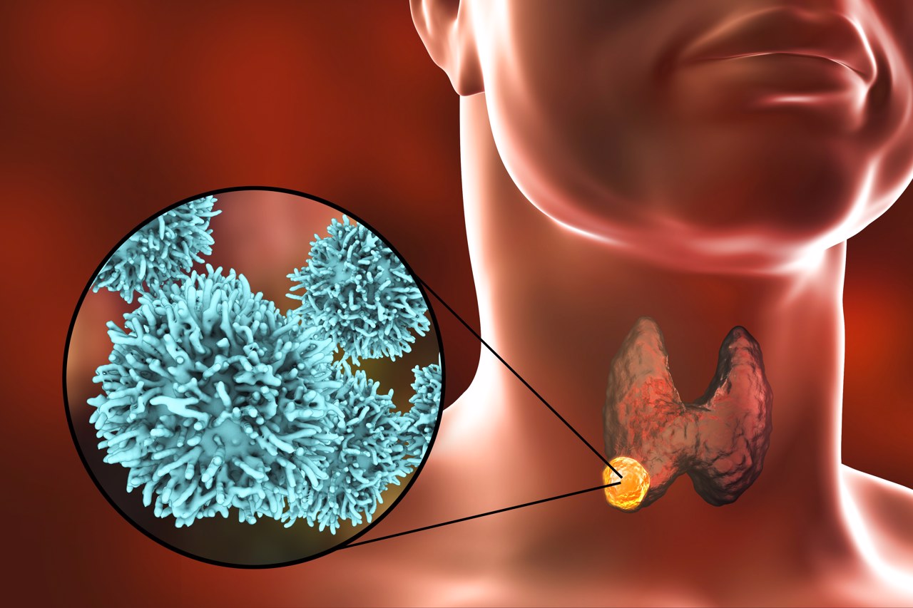 文献解读|Cell Rep Med（10.6）：蛋白质基因组学特征分析揭示了晚期
